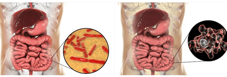 Quali fermenti per morbo di Crohn