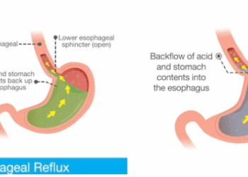reflusso gastrico cura