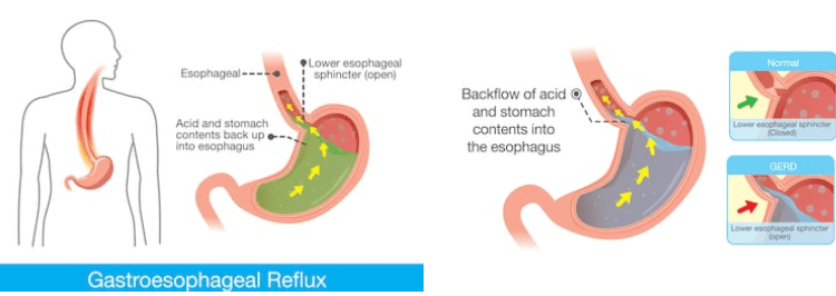 reflusso gastrico cura