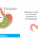 reflusso gastrico cura